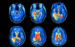 Reducing Excessive Microglia Activation to Reduce Neurodegeneration 
