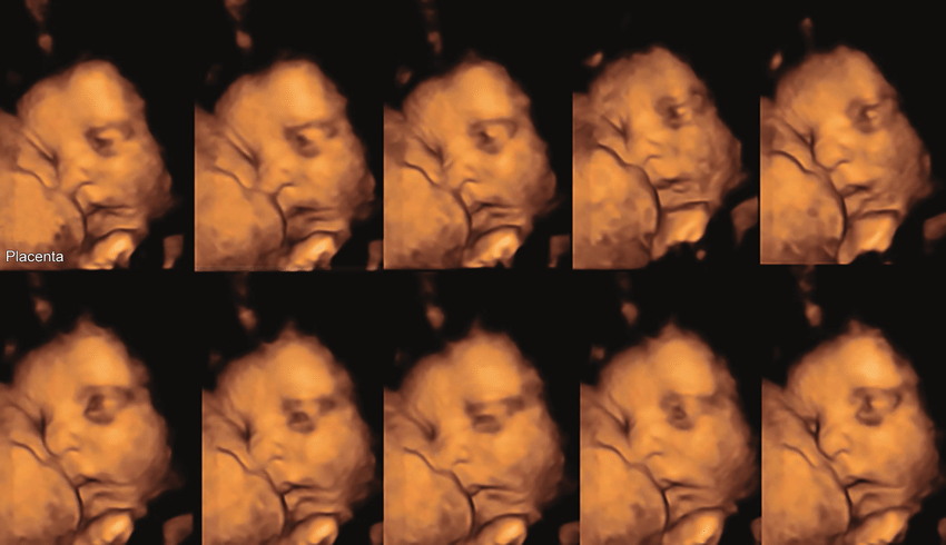 Project Outline: The impact of face-like and non-face-like light stimuli on fetal eye behaviour in utero: a study considering maternal mental health and fetal facial research methodology.