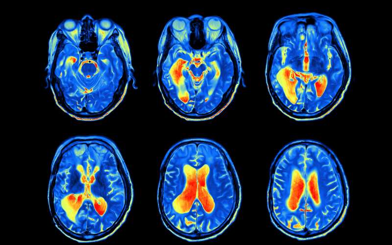 Reducing Excessive Microglia Activation to Reduce Neurodegeneration 